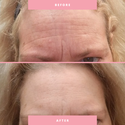 Lunelle Overnight Forehead Patch - Set of 3 Patches